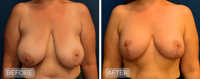 A result from John Park MD Plastic Surgery