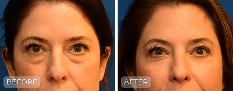 A result from John Park MD Plastic Surgery