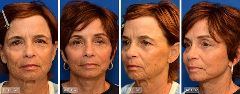 A result from John Park MD Plastic Surgery