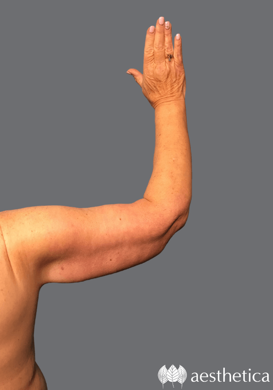 Arm Lift result at Aesthetica Plastic Surgery
