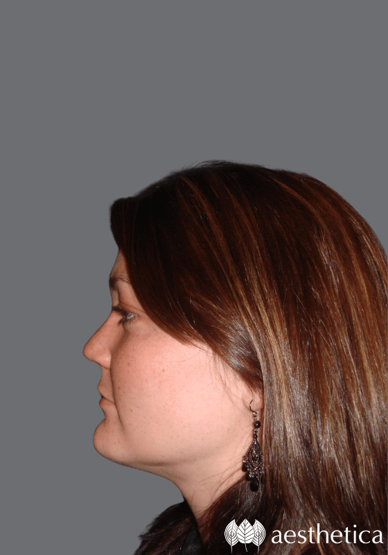Aesthetica Plastic Surgery neck lift after — Lindon, UT