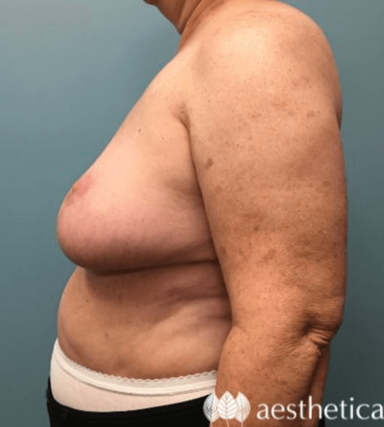 Breast Reduction result at Aesthetica Plastic Surgery