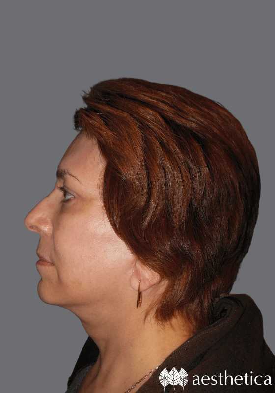Facelift result at Aesthetica Plastic Surgery