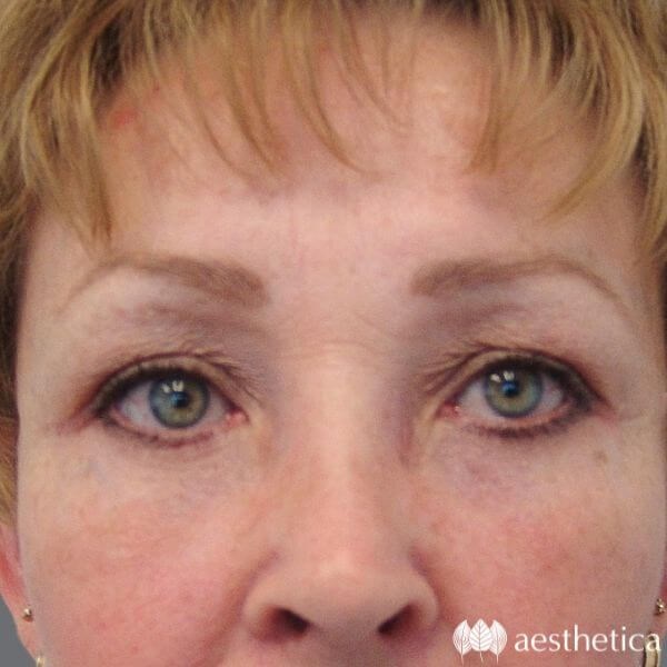 Brow Lift result at Aesthetica Plastic Surgery