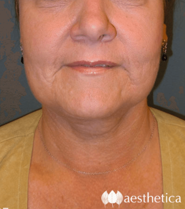 Aesthetica Plastic Surgery neck lift after — Lindon, UT