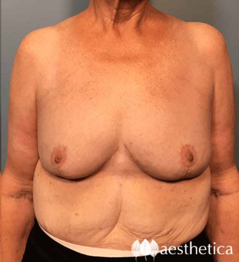 Breast Lift result at Aesthetica Plastic Surgery