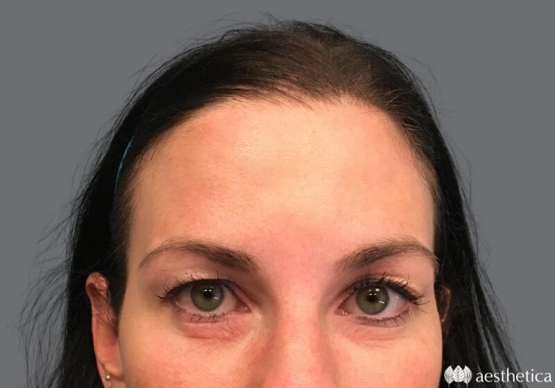 Blepharoplasty before photo