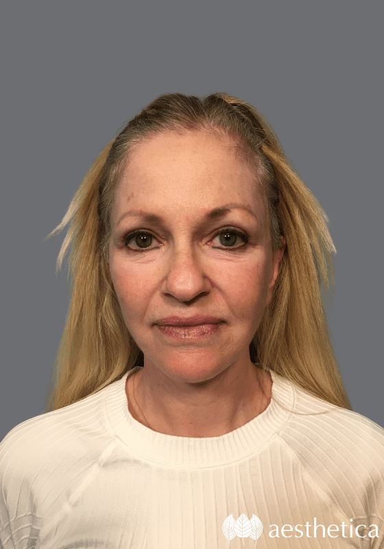 Facelift result at Aesthetica Plastic Surgery