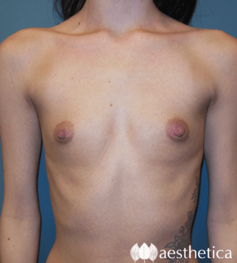 Breast Augmentation before photo