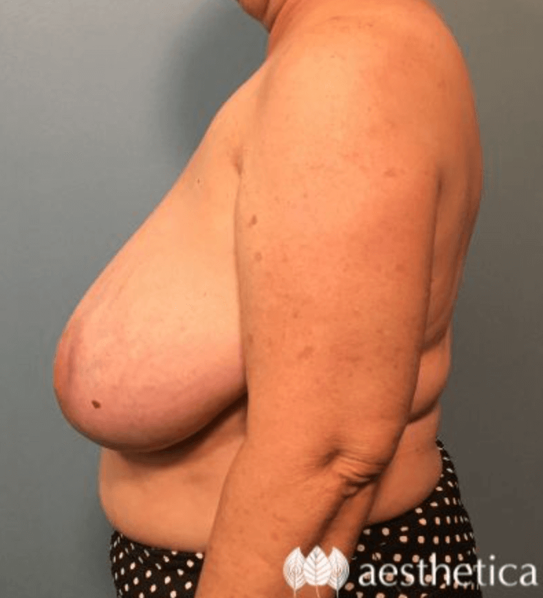 Breast Reduction before photo