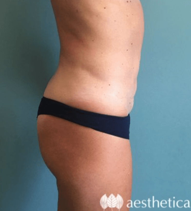Tummy Tuck before photo