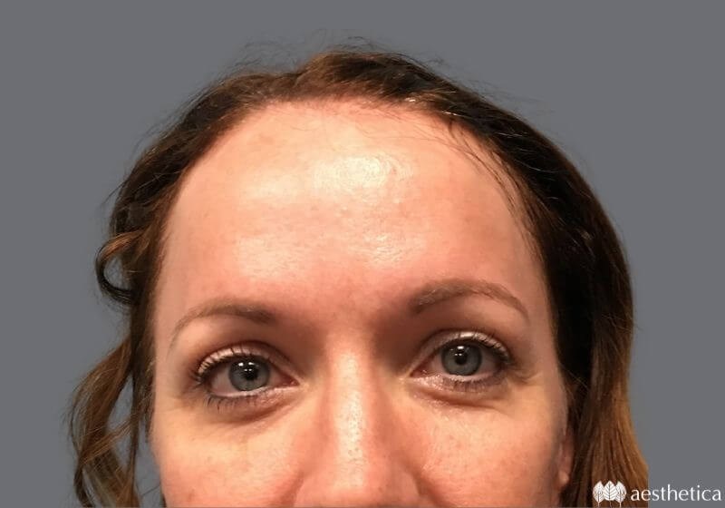 Blepharoplasty result at Aesthetica Plastic Surgery