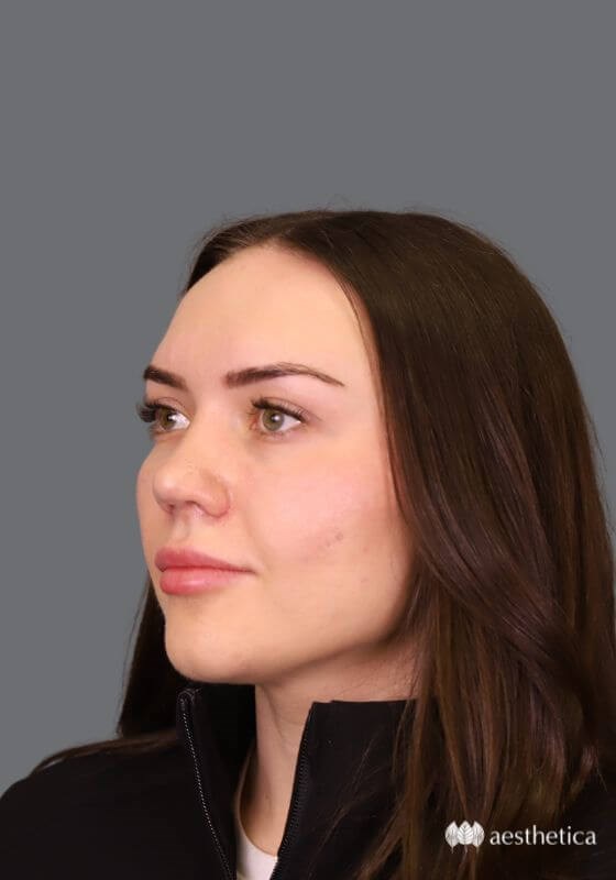 Rhinoplasty result at Aesthetica Plastic Surgery