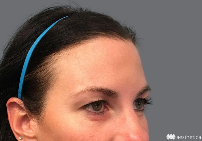 Blepharoplasty before photo
