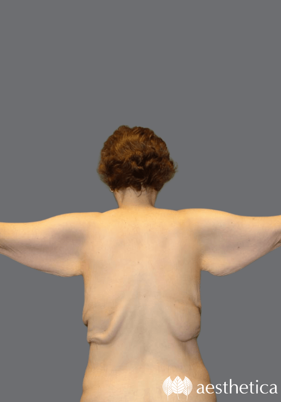 Arm Lift before photo