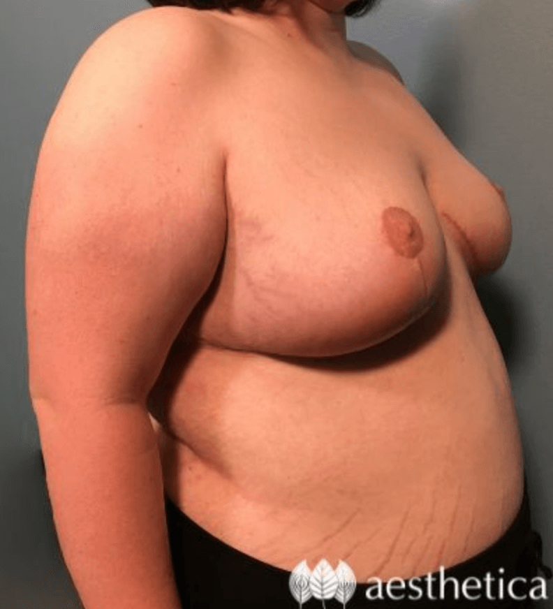 Breast Reduction result at Aesthetica Plastic Surgery