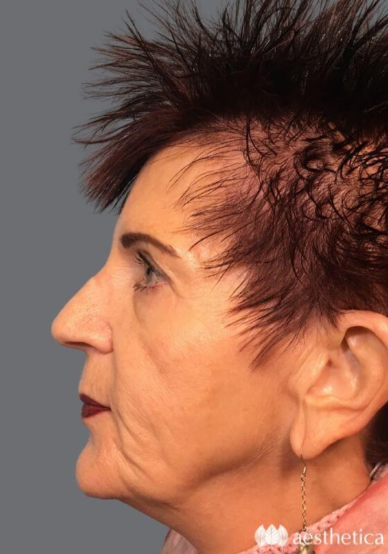 Brow Lift before photo