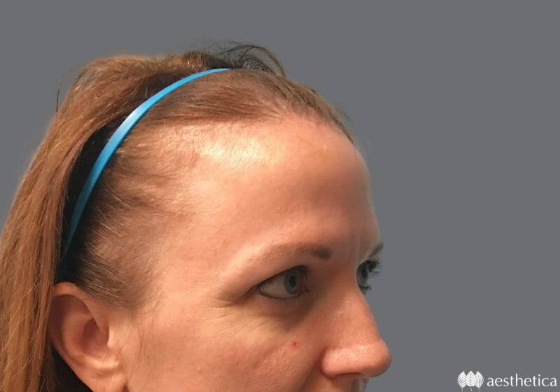 Blepharoplasty before photo