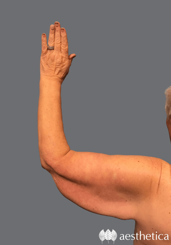 Arm Lift before photo