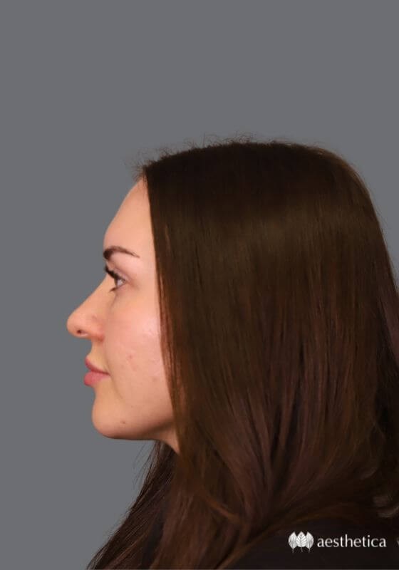 Rhinoplasty before photo