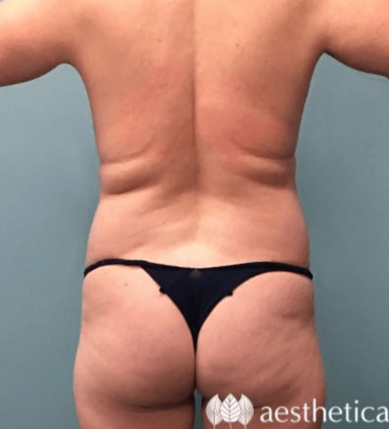 Tummy Tuck before photo