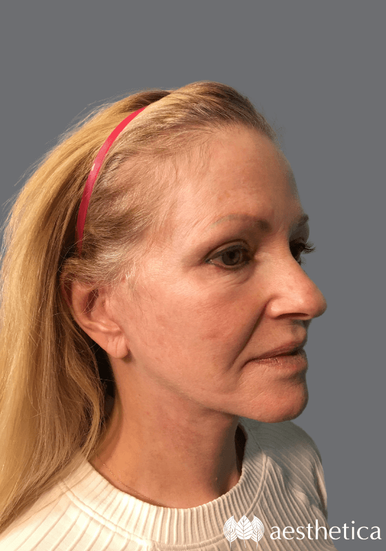 Facelift result at Aesthetica Plastic Surgery