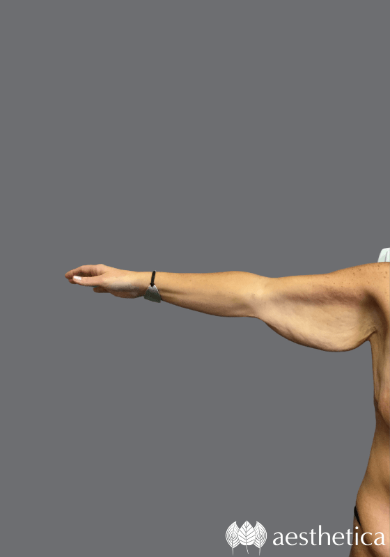 Arm Lift before photo