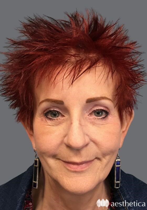 Brow Lift result at Aesthetica Plastic Surgery
