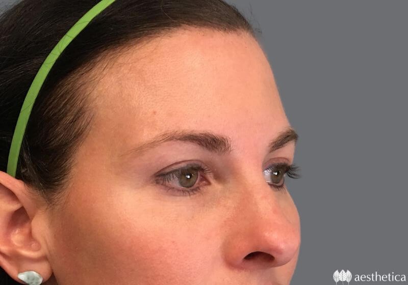 Blepharoplasty result at Aesthetica Plastic Surgery