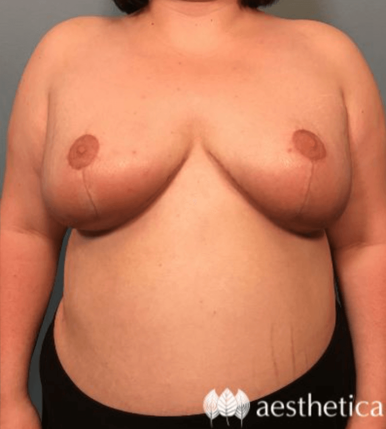 Breast Reduction result at Aesthetica Plastic Surgery