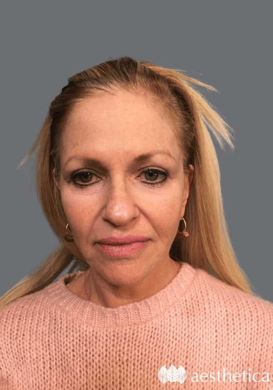 Facelift before photo