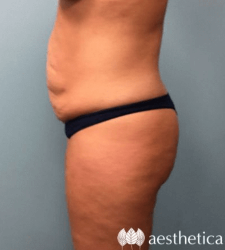 Tummy Tuck before photo