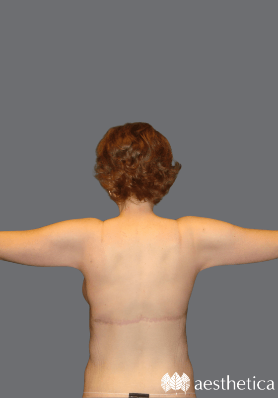 Arm Lift result at Aesthetica Plastic Surgery