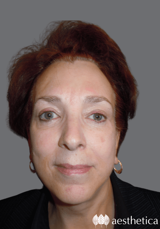 Facelift result at Aesthetica Plastic Surgery