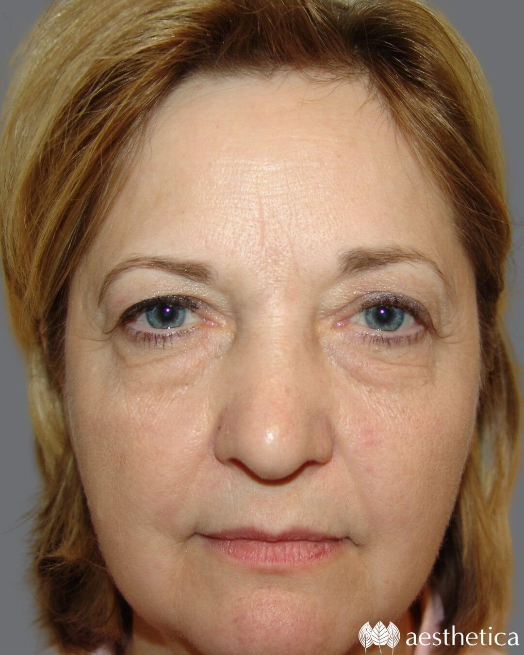 Blepharoplasty before photo