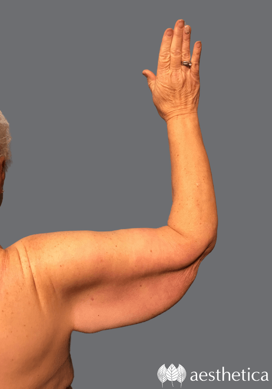 Arm Lift before photo