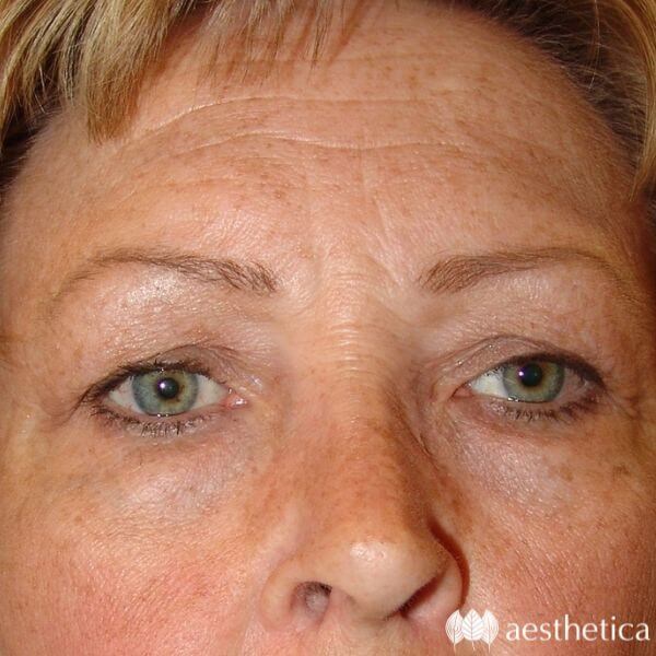 Brow Lift before photo