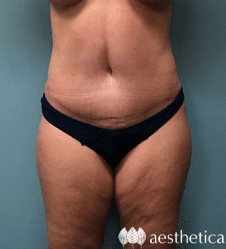 Tummy Tuck result at Aesthetica Plastic Surgery