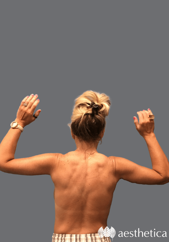Arm Lift result at Aesthetica Plastic Surgery