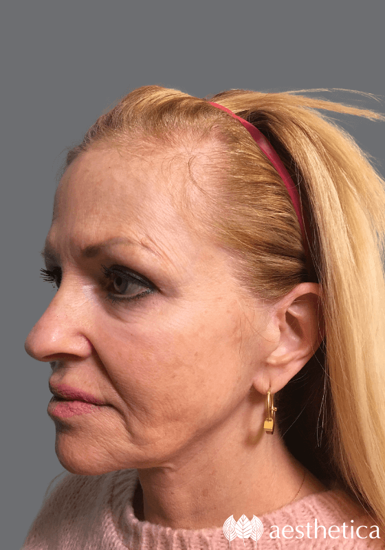 Facelift before photo
