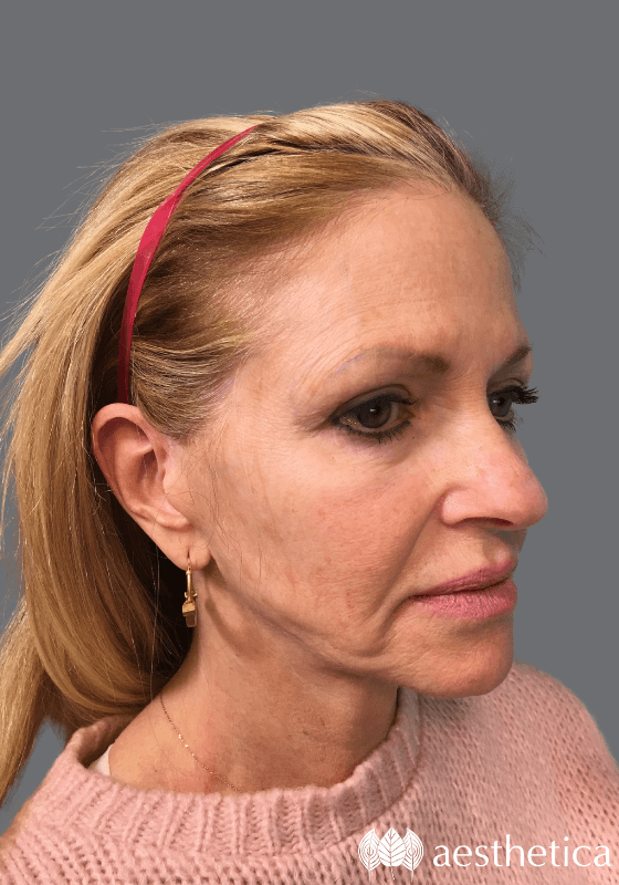 Facelift before photo