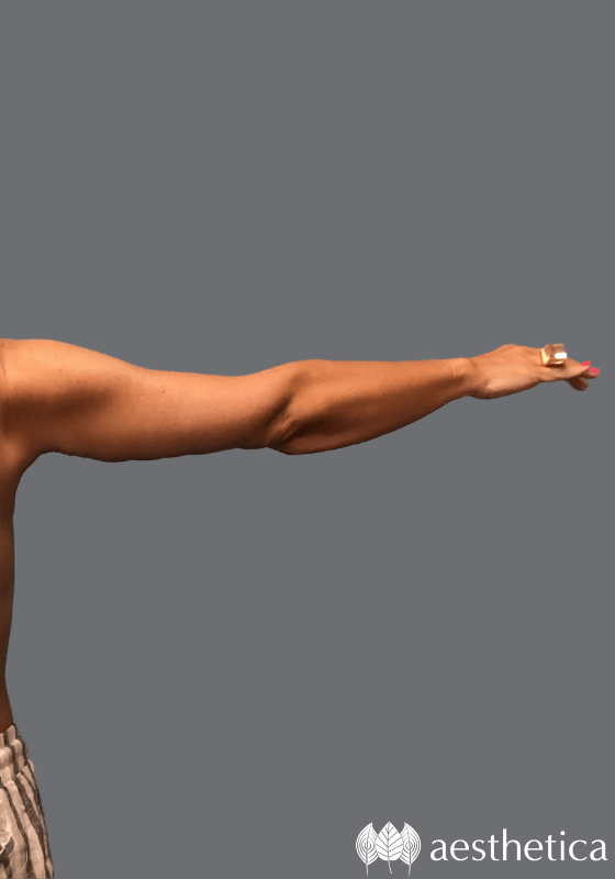 Arm Lift result at Aesthetica Plastic Surgery