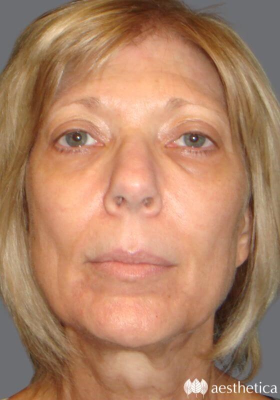 Blepharoplasty result at Aesthetica Plastic Surgery