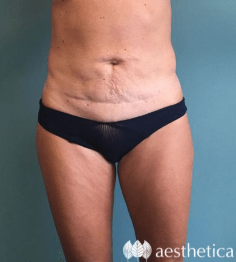 Tummy Tuck before photo