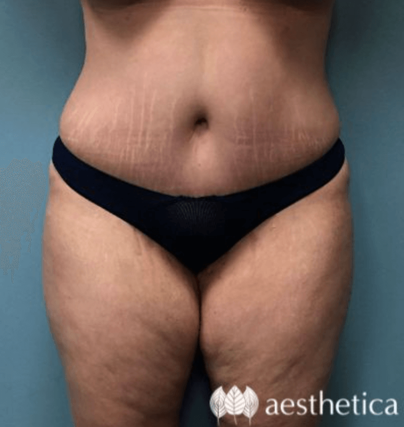 Tummy Tuck result at Aesthetica Plastic Surgery