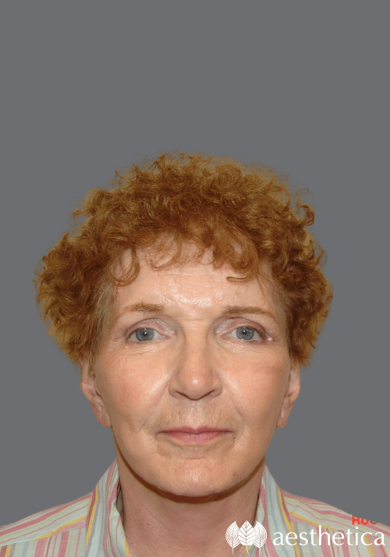 Facelift result at Aesthetica Plastic Surgery