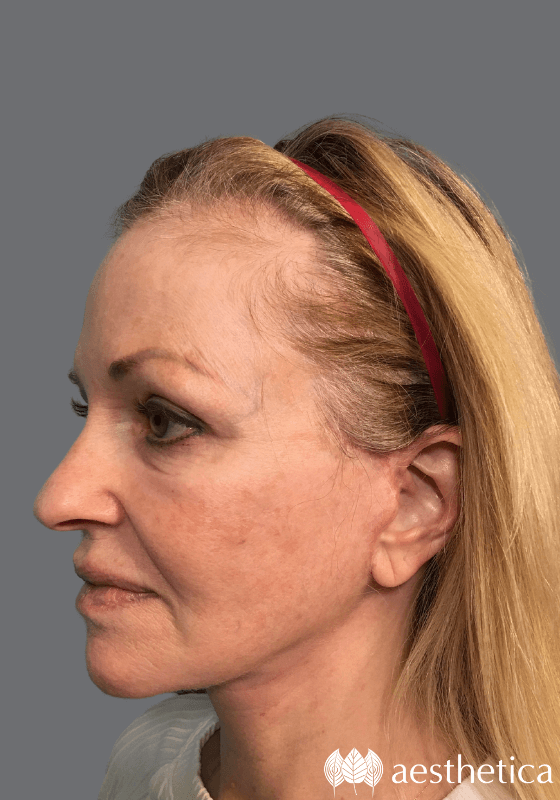 Facelift result at Aesthetica Plastic Surgery
