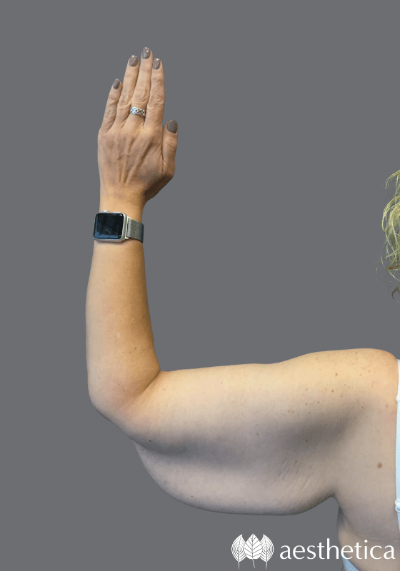 Arm Lift before photo