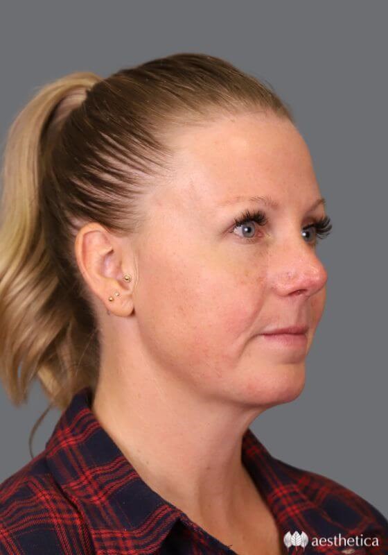 Aesthetica Plastic Surgery rhinoplasty after — Lindon, UT