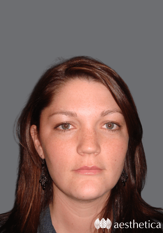 Aesthetica Plastic Surgery neck lift after — Lindon, UT